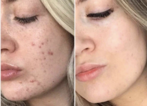 Kvinna med acne före och efter behandling